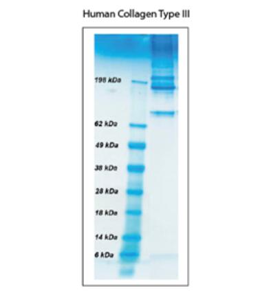 Characteristic; approximately 85% Type III and 15% Type I